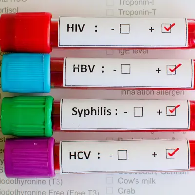 Sexually Transmitted Infections or STIs